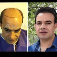 کلینیک تخصصی کاشت موی آوات