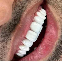 جشنواره کامپوزیت لمینت ، روکش|خدمات آرایشگری و زیبایی|تهران, دردشت|دیوار