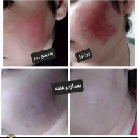 ترمیم زخم سوختگی|آرایشی، بهداشتی، درمانی|قم, حنیف نژاد|دیوار