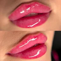 تزریق ژل بوتاکس زاویه سازی زیبایی فیلر