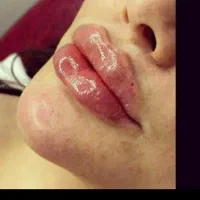 ژل .بوتاکس .هایفو.ساکشن غبغب وساکشن شکم وپهلو|خدمات آرایشگری و زیبایی|اصفهان, رکن الدوله غربی|دیوار