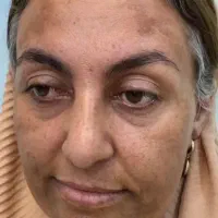 فروش کرم های ضد لک|آرایشی، بهداشتی، درمانی|قائمشهر, |دیوار