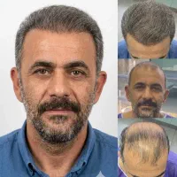 کلینیک کاشت مو تضمینی در بیمارستان ارتش همدان