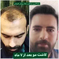 کاشت مو روش سوپر FUE پلاس(روش شیرازی)فقط ۱۵ میلیون|خدمات آرایشگری و زیبایی|یزد, |دیوار