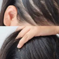 درمان ریزش مو، بدون شیمیایی و هزینه های کلان