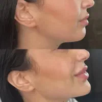 تخفیفات بزرگژل وبوتاکس در مشهد|خدمات آرایشگری و زیبایی|مشهد, کوثر|دیوار