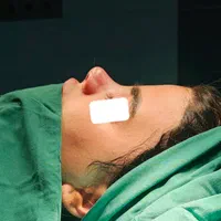 جراحی زیبایی بینی (رینوپلاستی)