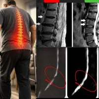 اگه میخوای از شر دیسک تنگی کانال نخاعی و.. خلاص شی