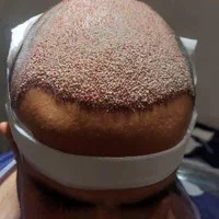 کاشت تخصصی مو در شیراز