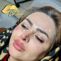 تزریق تخصصی فیلر زیر چشم بینی ژل لب روسی لیفت گونه|خدمات آرایشگری و زیبایی|تهران, پونک|دیوار