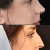 جراحی تیپ‌پلاستی بینی بصورت اقساط۱۸ ماهه|خدمات آرایشگری و زیبایی|خرم‌آباد, |دیوار