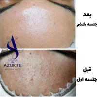 فیشیال وپاکسازی پوست۳۹۰،جوانسازی،جوش،لک،جای جوش