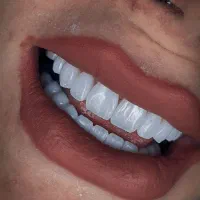 جشنواره بمناسبت روز مادر ایمپلنت، عصب کشی، جراحی،