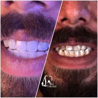 ایمپلنت و زیبایی دندان اقساط ۱۲ ماهه اکو دنتال