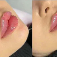 ژل/بوتاکس/میکروبلیدینگ ابرو/شید لب با تنوع قیمت