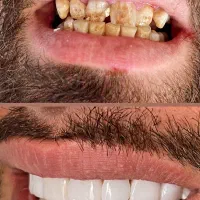 اقساط زیبایی ایمپلنت لمینیت کامپوزیت سجاد بهارستان|خدمات آرایشگری و زیبایی|مشهد, سجاد شهر|دیوار