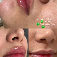 تخفیف ویژه در تزریق ژل و بوتاکس