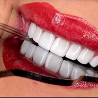 جشنواره دندان ونیر کامپوزیت روکش لمینیت عصب ترمیم|خدمات آرایشگری و زیبایی|تهران, هفت حوض|دیوار