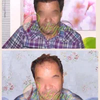 کاشت فوق تخصصی مو‌. ریش  ابرو. لیزرالکس‌مو‌زائد