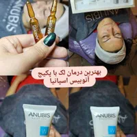 پاکسازی و فیشال /درمان جوش و لک و منافذباز|خدمات آرایشگری و زیبایی|کرمانشاه, |دیوار