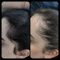 استخدام دستیار کراتین و اسکراب اسکالپ