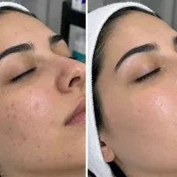 پاکسازی صورت وی ای پی