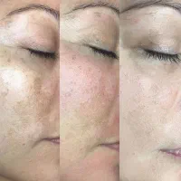 لیزر موهای زائدروشن کننده ورفع لک رفع منافذبوتاکس|خدمات آرایشگری و زیبایی|رشت, بوسار|دیوار