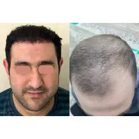 کاشت مو قسطی شد|خدمات آرایشگری و زیبایی|ملکان, |دیوار