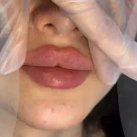 تزریق فیلر و بوتاکس اقساط توسط پزشک در مطب|خدمات آرایشگری و زیبایی|خرمشهر, |دیوار