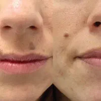 خال برداری رفع کک و مک با لیزر|خدمات آرایشگری و زیبایی|هشتگرد, مدرس|دیوار