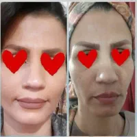 پک چاقی صورت