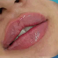 تخفیفات ۵۰% دکتر بوتاکس مزو فیلر ژل لب روسی|خدمات آرایشگری و زیبایی|مشهد, هنرستان|دیوار