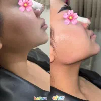 تزریق فیلر،ژل لب،فیلربینی