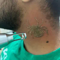 مرکزپاک کردن تتو/کیوسیچ لیز/خال کوبی/فیلر بوتاکس|خدمات آرایشگری و زیبایی|اصفهان, عباس‌آباد|دیوار