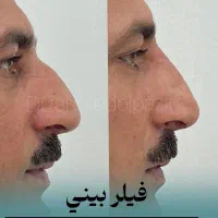 خالبرداری،حذف تاتو با لیزر و تمامی تزریقات زیبایی|خدمات آرایشگری و زیبایی|شیراز, گلدشت معالی‌آباد|دیوار