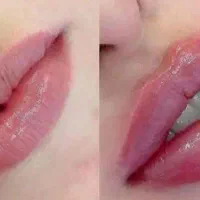 جشنواره خدمات ژل و بوتاکس و مزو ژل و آنزیم و....