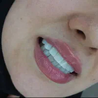 زیبایی،کامپوزیت دندان،عصب کشی(یاسوج)|خدمات آرایشگری و زیبایی|دوگنبدان, |دیوار