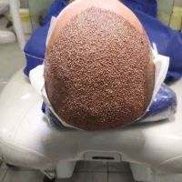 بیا اقساطی مو بکار کاشت مو و ابرو و ریش تضمینی|خدمات آرایشگری و زیبایی|ارومیه, |دیوار
