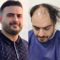 مرکز تخصصی کاشت مو و ابرو احمدیه  اژکان