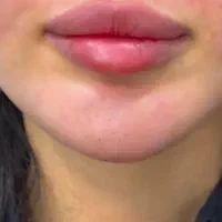 ژل فیلرسیسی(۸۲۰ لب.۸۰۰صورت)آقایان و بانوان|خدمات آرایشگری و زیبایی|زاهدان, |دیوار
