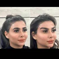 تزریق ژل فیلر مزوژل جوانساز بوتاکس لب روسی مزو مو|خدمات آرایشگری و زیبایی|کرج, گلشهر|دیوار