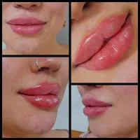 فیلر و ژل و بوتاکس و جوانسازی صورت و بدن