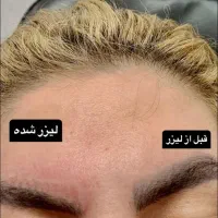 کربن تراپی لیزر کیوسوئیچ بستن منافذ|خدمات آرایشگری و زیبایی|دهدشت, |دیوار