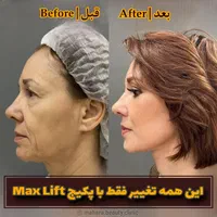 جشنواره جوانسازی Max Lift پزشک پوست مو بینی زیبایی|خدمات آرایشگری و زیبایی|مشهد, هفت تیر (حافظ)|دیوار