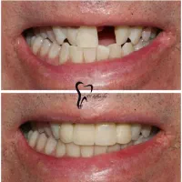 وام دندانپزشکی ایمپلنت|خدمات آرایشگری و زیبایی|رباط‌کریم, رباط‌کریم|دیوار