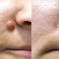 جشنواره برداشتن خال /  خال گوشتی /  میلیا