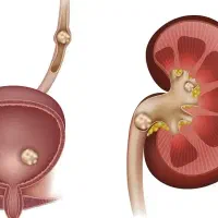 سنگ کلیه