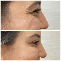 تزریق ژل و بوتاکس در مطب پزشک