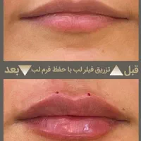 تزریق حرفه ای فیلر در کلینیک زیبایی و لیزر راویس|خدمات آرایشگری و زیبایی|کاشان, رجایی|دیوار