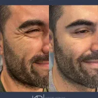 جشنواره ۵۰درصد تخفیف بوتاکس مخصوص خانم ها و آقایان|خدمات آرایشگری و زیبایی|دزفول, |دیوار